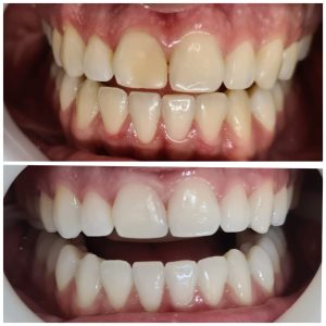 antes e depois - dra gabriella fortes (1)