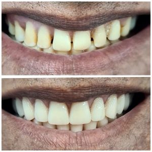 antes e depois - dra gabriella fortes (2)