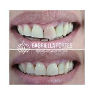 antes e depois - dra gabriella fortes (3)