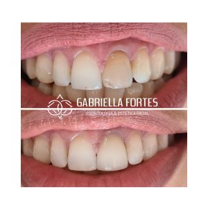 antes e depois - dra gabriella fortes (4)