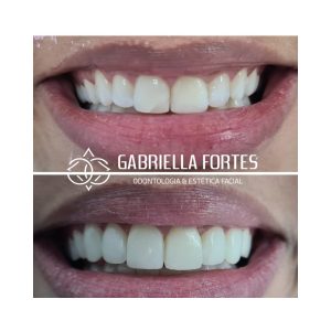 antes e depois - dra gabriella fortes (5)