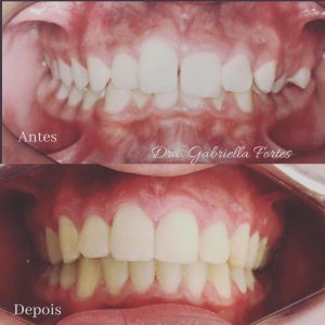 antes e depois - dra gabriella fortes (6)