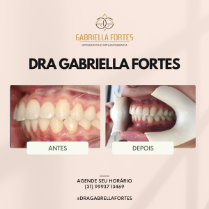 antes e depois - dra gabriella fortes_ (1)