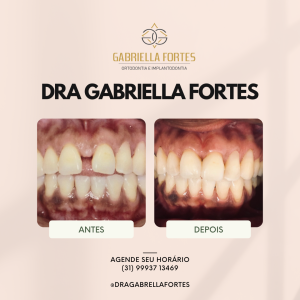 antes e depois - dra gabriella fortes_ (2)