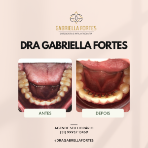 antes e depois - dra gabriella fortes_ (3)