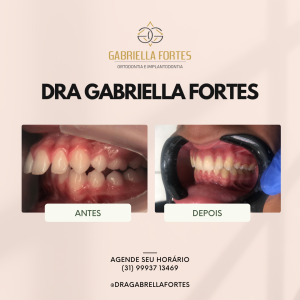 antes e depois - dra gabriella fortes_ (4)