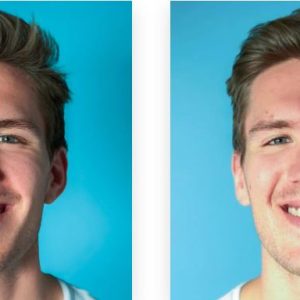 antes e depois invisalign