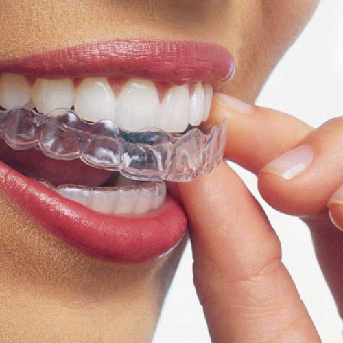 INVISALIGN