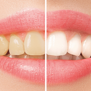 clareamento dental
